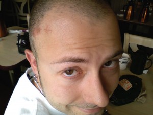 Forehead wound Forehead wound