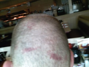 Bruises on the back of my head Bruises on the back of my head